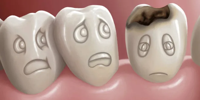 وصفة طبيعية للقضاء على التسوس ولا داعي للحشو